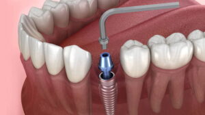 Показания для восстановления зубов коронкой