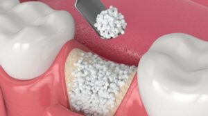 Пластика костной ткани: создание условий для успешной имплантации зубов