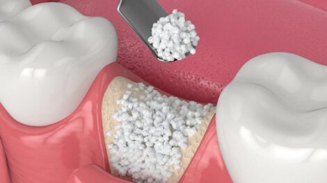 Пластика кісткової тканини: створення умов для успішної імплантації зубів