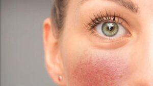 Современные методы лечения купероза